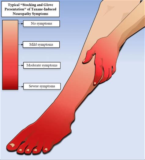 stocking glove syndrome|PERIPHERAL NEUROPATHY Ralph F. Józefowicz, MD。